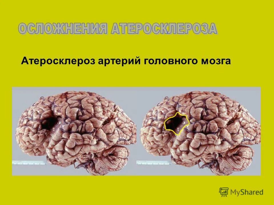 Атеросклероз церебральных сосудов симптомы. Атеросклероз сосудов головного мозга макропрепарат. Атеросклероз головного мозга патанатомия. Атеросклероз артерий основания головного мозга макропрепарат. Осложнения атеросклероза артерий головного мозга.