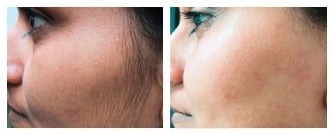 Лазерная эпиляция лица для мужчин. Можно ли делать лазерную эпиляцию на лице. Можно ли делать лазерную эпиляцию на лице. Лазерная эпиляция лица до и после. Эпиляция лица для женщин.