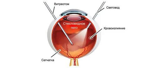 Витрэктомия глаза