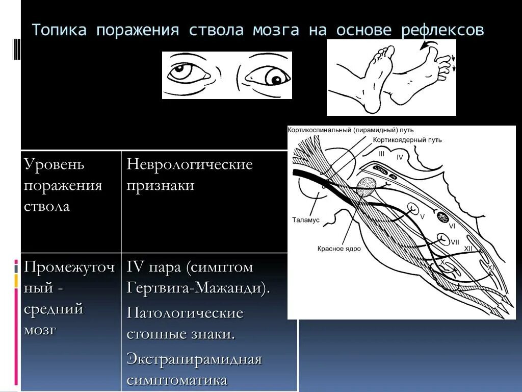 Поражение ствола головного. Симптомы поражения ствола головного мозга неврология. Рефлекс Гертвига Мажанди. Синдромы при поражении ствола головного мозга.