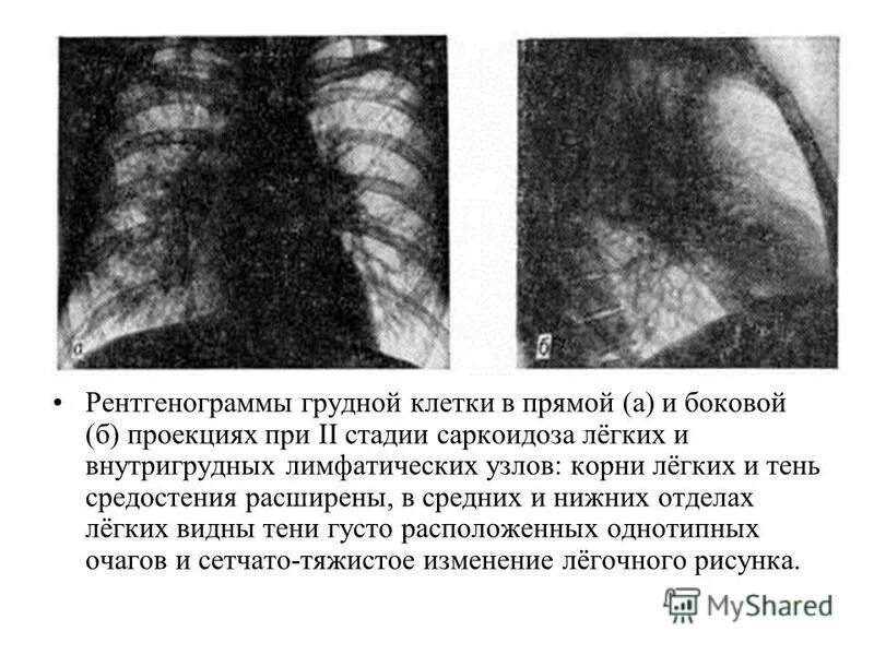 Увеличение лимфоузлов в легких причины. Саркоидоз внутригрудных лимфоузлов рентген. Саркоидоз внутригрудных лимфатических узлов рентген. Лимфаденопатия внутригрудных лимфоузлов рентген. Саркоидоз легких 2 стадия рентген.