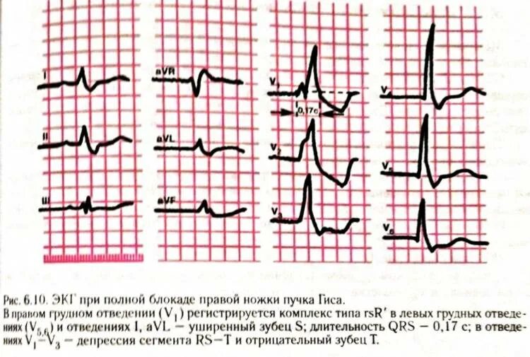 Опасна ли неполная блокада. Неполная блокада левой ножки пучка Гиса на ЭКГ. Блокада ЛНПГ на ЭКГ. Неполная блокада передней ветви ЛНПГ на ЭКГ. Блокада левой ножки пучка Гиса на ЭКГ.