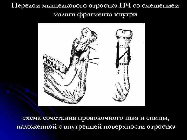 Перелом нижней челюсти на кт. Перелом суставного отростка челюсти. Перелом суставного отростка челюсти. Закрытый перелом мыщелкового отростка нижней челюсти. Перелом мыщелкового отростка нижней челюсти.