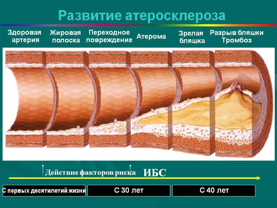 Развитие атеросклероза. Стадии развития атеросклероза. стадии развития бляшки. этапы формирования атеросклеротической бляшки. периоды развития атеросклероза.
