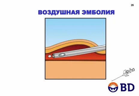 Воздушная эмболия