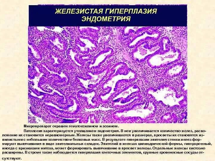 Что значит железистая гиперплазия эндометрия. Гиперплазия эндометрия микропрепарат. железистая гиперплазия эндометрия гистология. железистая гиперплазия слизистой оболочки матки микропрепарат. гиперплазия слизистой оболочки матки микропрепарат.