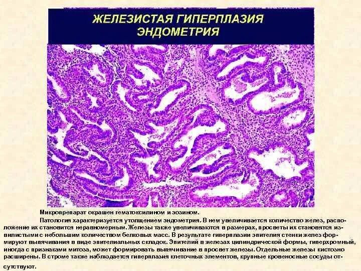 Гиперплазия эндометрия микропрепарат. Железисто-кистозная гиперплазия эндометрия микропрепарат. Железистая гиперплазия эндометрия гистология. Железистая гиперплазия слизистой оболочки матки микропрепарат.