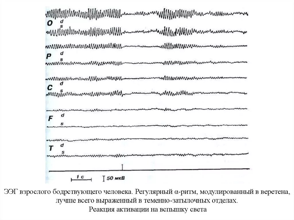 Реакция ээг. Ритмы ЭЭГ В норме. Норма Дельта ритма на ЭЭГ. Модулированный ритм ЭЭГ. Дельта ритм на ЭЭГ У взрослых.