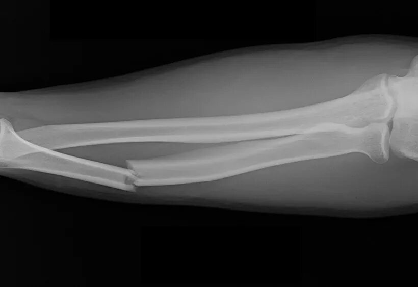 Открытый перелом кости руки. Рентген перелома кости предплечья. Перелом костей предплечья рентген. Перелом кости руки рентген. Переломы верхней конечности рентген.