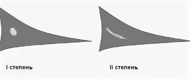 Разрыв мениска степени по stoller. Столлер классификация менисков. Классификация разрывов мениска по Stoller. Классификация повреждения менисков по Stoller. Повреждение мениска по Stoller.