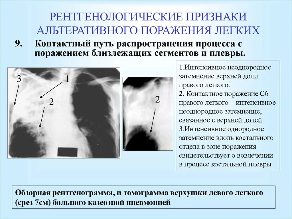 1 поражения легких. Признаки поражения легких. Симптомы поражён лёгких. Поражение лёгких симптомы. Признаки поражения лёгкого.