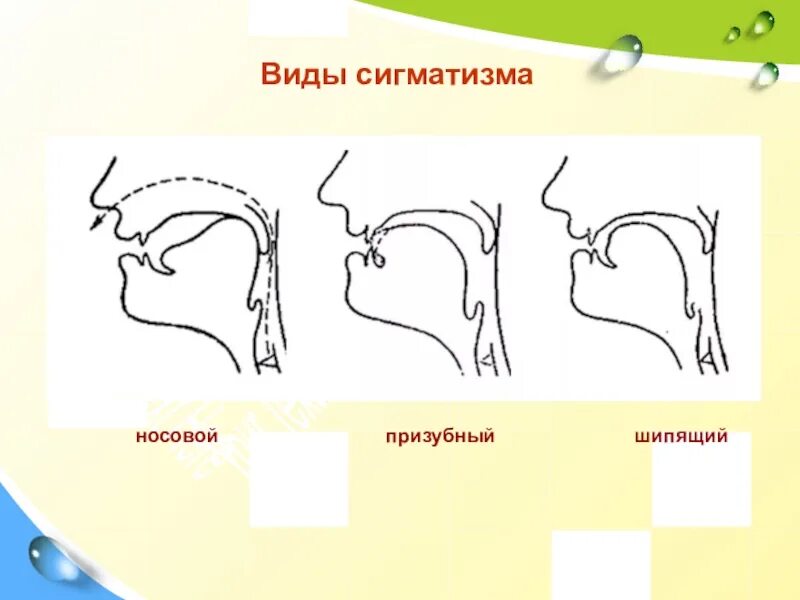 Межзубный сигматизм шипящих звуков. Носовой сигматизм. Сигматизм свистящих звуков. Профили артикуляции свистящих звуков при ринолалии. Виды артикуляции