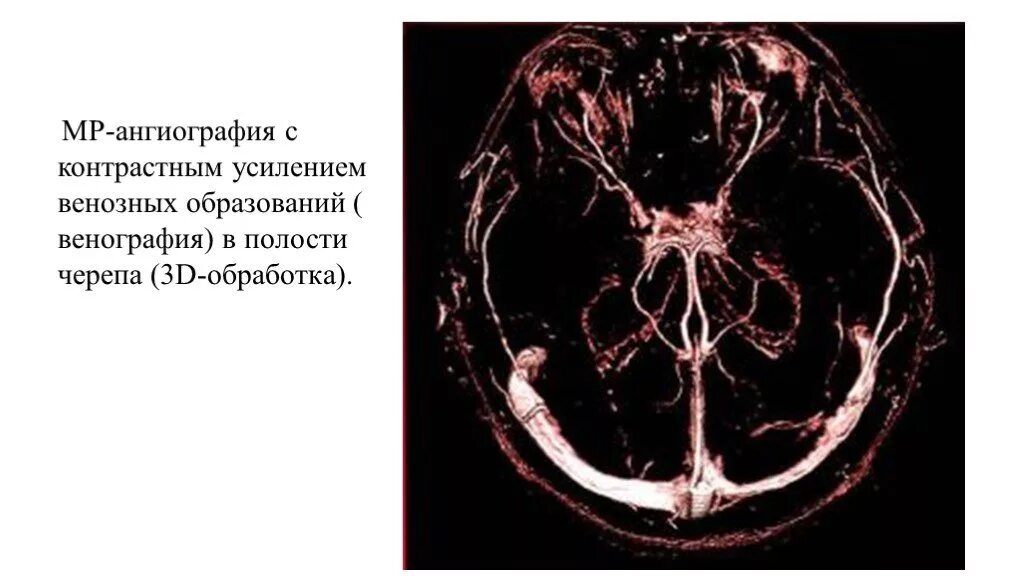 Венография головного мозга. Венография головного мозга мрт. Магнитно-резонансная спектроскопия (МРС). Ангиография и венография головного мозга что это. МР венография.