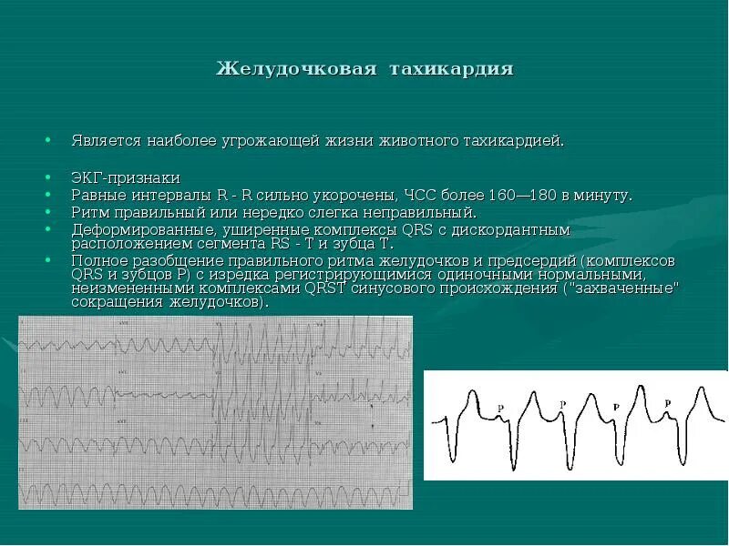 Желудочковая тахикардия на экг. Пароксизмальная желудочковая тахикардия на ЭКГ. ЭКГ признаки пароксизмальной желудочковой тахикардии. Правожелудочковая тахикардия на ЭКГ. Мономорфная желудочковая тахикардия ЭКГ.