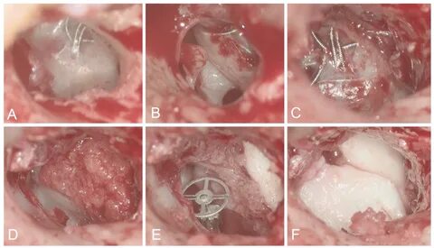Figure 2. Revision surgery of case 1 due to transtympanic coil migration. 