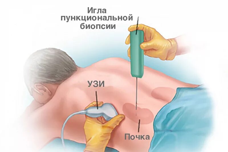 Чрескожная пункционная биопсия почки. Техника пункционная биопсию почки. Чрескожная биопсия печени. Тонкоигольная аспирационная биопсия печени.