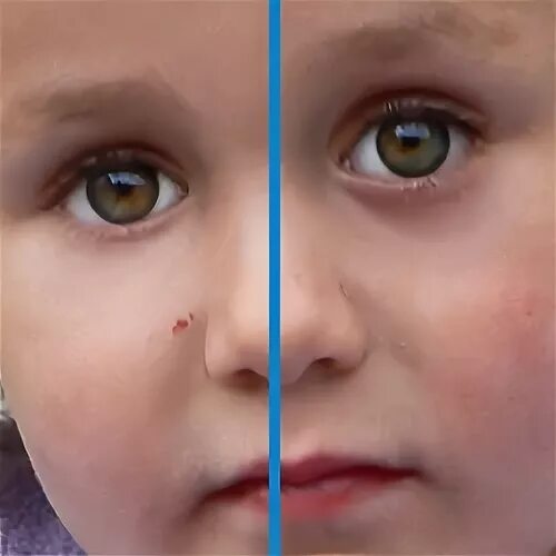 Тёмные круги под глазами у ребёнка. Мешки под глазами у ребенка. Синие круги под глазами у ребенка.