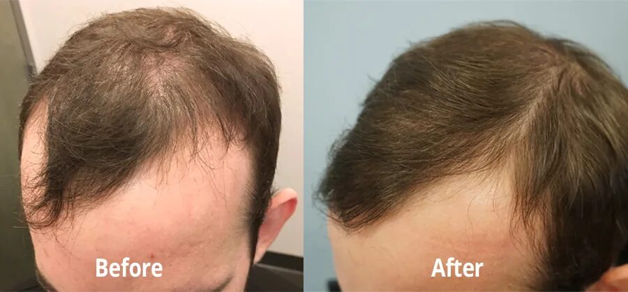 Стимулирование волос. Контроль выпадения волос. NOFAP уровень выпадения волос. Шлем для роста волос. Этапы отрастания волос на голове у мужчин фото.