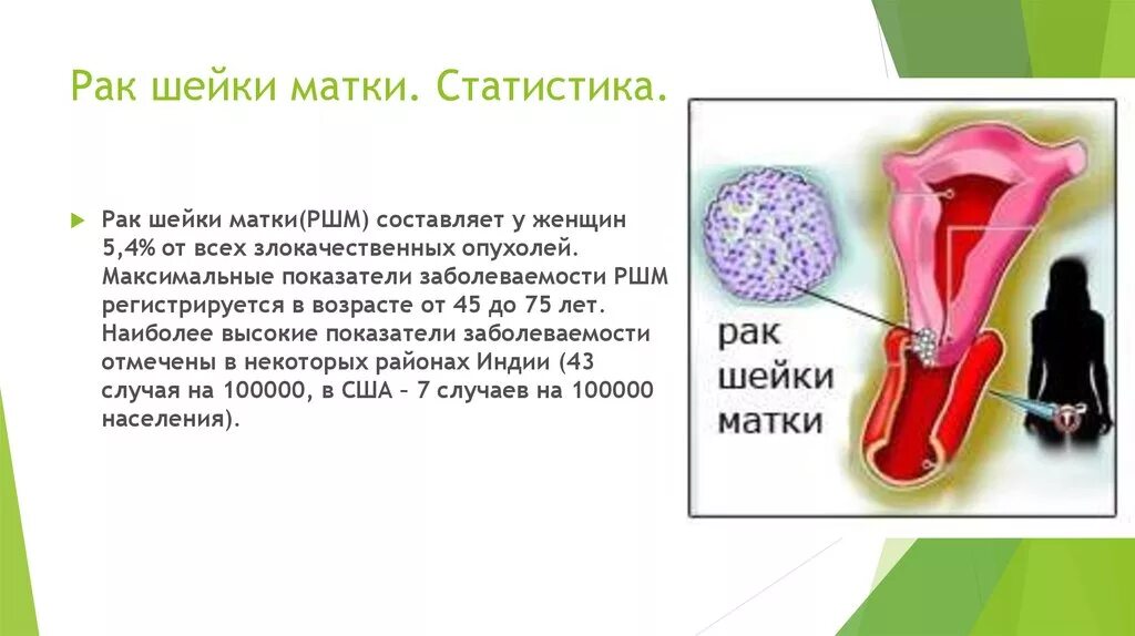 Вирус рака шейки матки. Цервикальная карцинома шейки матки.