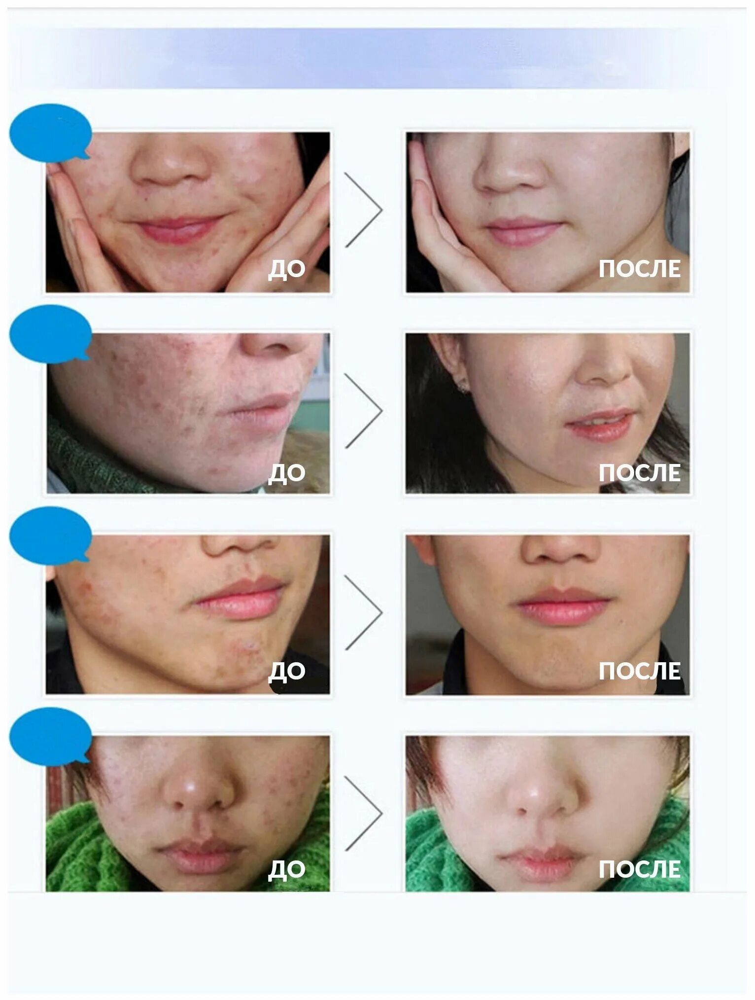 Bioaqua сыворотка от акне pure skin. крем для лица bioaqua pure skin, 30 г. Bioaqua anti acne сыворотка. сыворотка от прыщей акне. сыворотка «биоаква» анти-акне(0726).