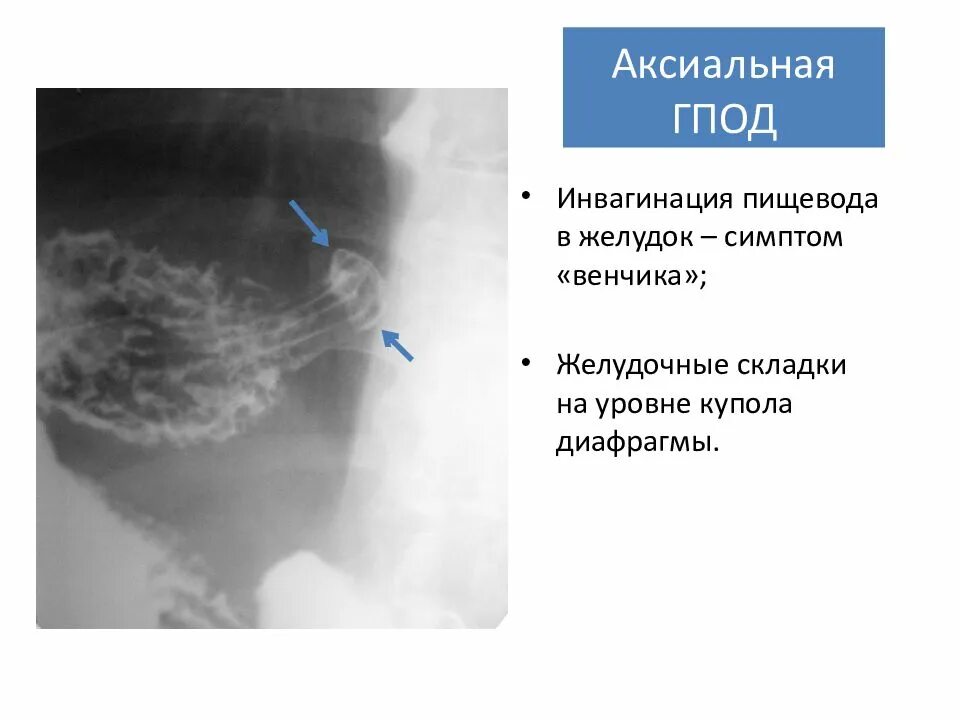 Грыжа пищевода признаки симптомы. Аксиальная грыжа пищеводного отверстия симптомы. Грыжа пищевого отдела диафрагмы. Рентген признак грыжа пищеводного.