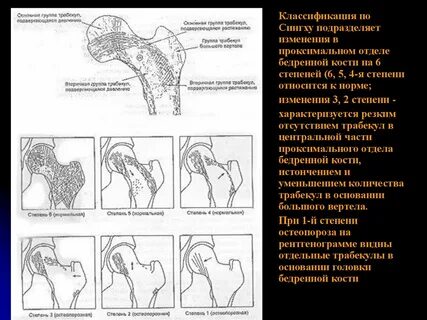 Изменения бедренной кости