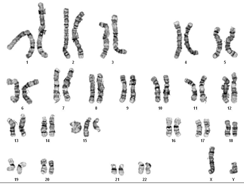 Хромосомы краба. ATCC CRL-1711 karyotype 2n. Синдром Видемана Беквита кариотип. Хромосома кривая. Лейкоз кариотип.