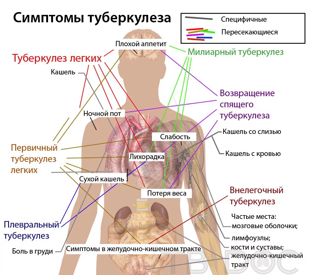 Симптомитика туберкулез. Симптомы проявления туберкулеза.