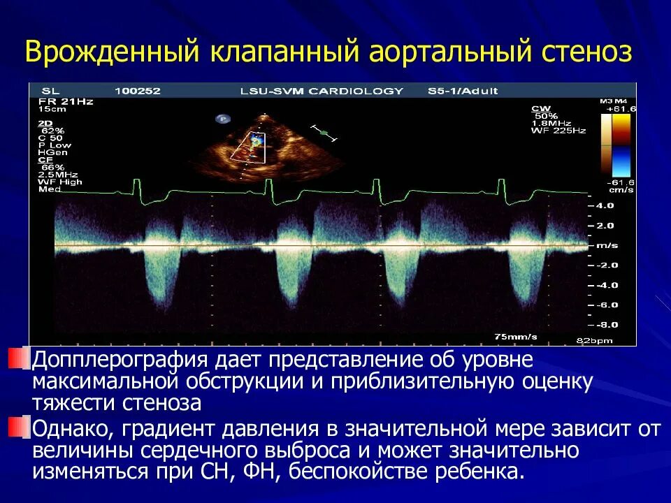 Градиент давления клапанов норма. Эхокг измерение градиента давления на аортальном клапане. аортальный стеноз допплерография. трансаортальный градиент давления в норме. градиент давления макс эхокг.