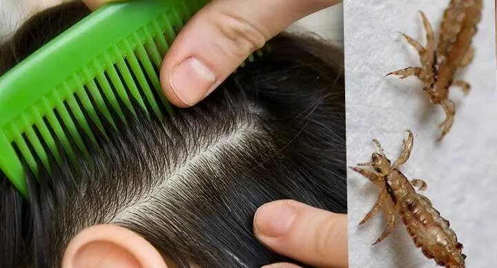 ما أسباب القشرة في الرأس Head louse, Louse, Egg for hair
