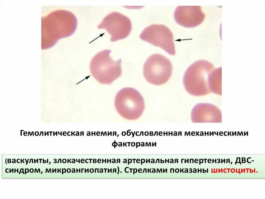 Аутоиммунная гемолитическая анемия картина крови. Гемолитическая анемия акантоциты. Гемолитические анемии. Картина периферической крови.. Приобретенная гемолитическая анемия картина крови.