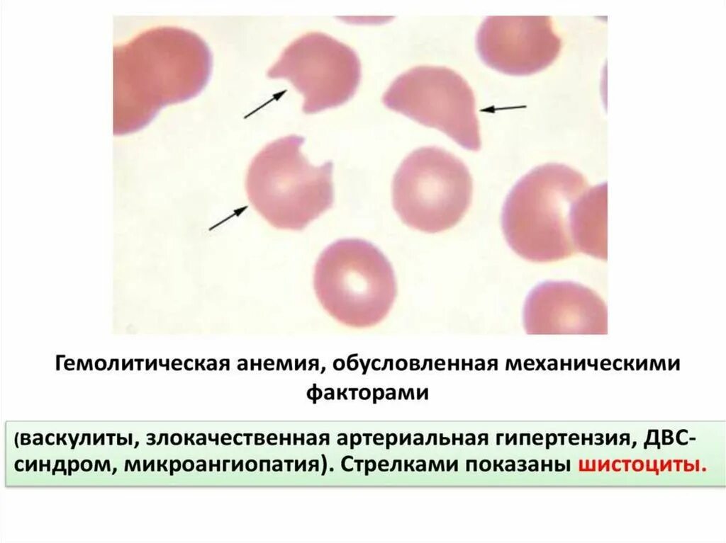 Анемия гемолитического типа. Аутоиммунная гемолитическая анемия картина крови. Гемолитическая анемия акантоциты. Гемолитические анемии. Картина периферической крови.. Приобретенная гемолитическая анемия картина крови.