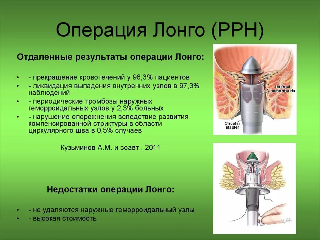 Степлерная геморроидопексия (операция Лонго). Степлерная геморроидэктомия операция Лонго. Наружные и внутренние геморроидальные узлы. Выпадение внутренних геморроидальных узлов.