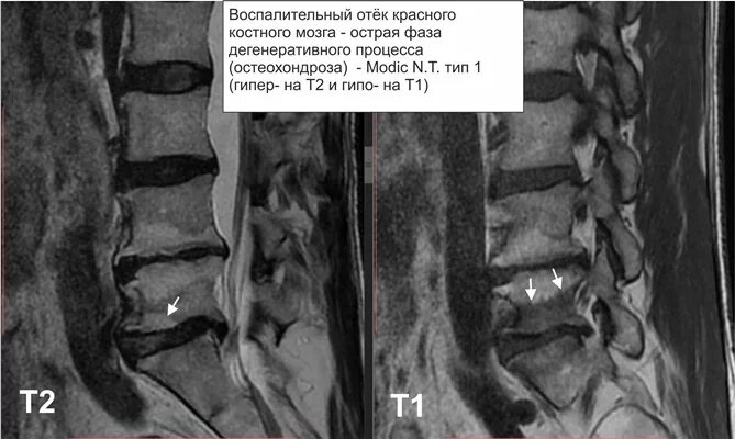 Трабекулярный отек позвонка l5 s1. Трабекулярный отек тела позвонка l5 s1. Реконверсия костного мозга мрт позвоночника. Реактивный отек костного мозга тела позвонка с6.