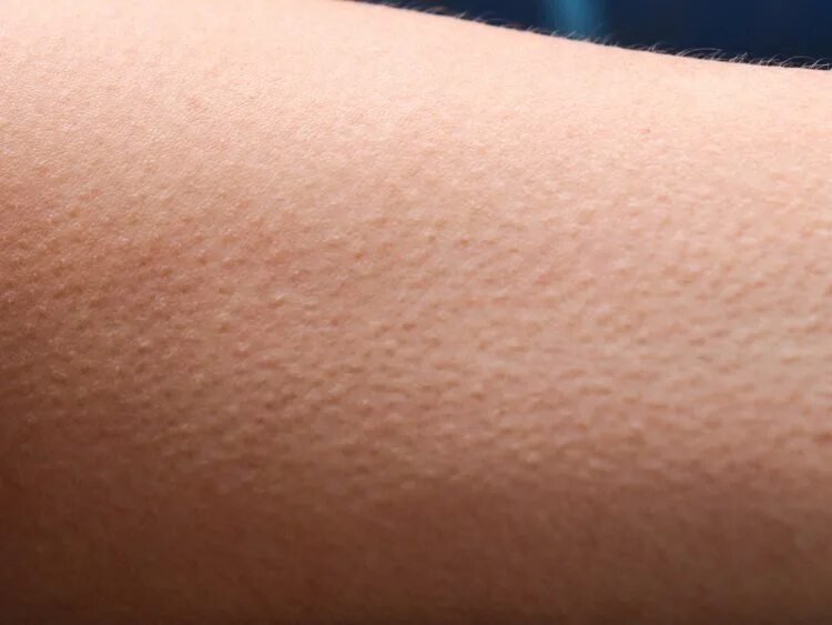 Фолликулярный кератоз гусиная кожа. Мелкая бесцветная сыпь. Сыпь как гусиная кожа у ребенка. Фолликулярный катороз. Сыпь как гусиная кожа у ребенка.