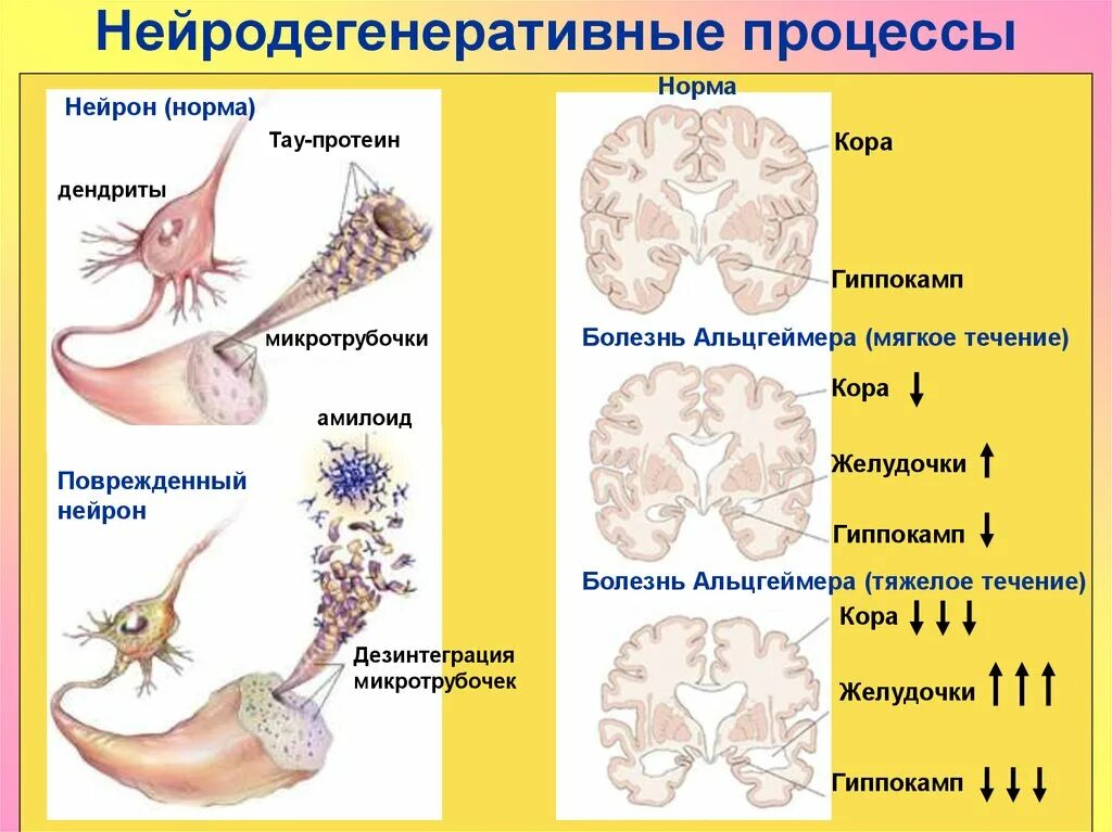 Дегенеративные изменения цнс. Нейродегенеративные заболевания. нейродегенеративныетзабрлевания. нейродегенеративное заболевание головного мозга. нейродегенеративные процессы.