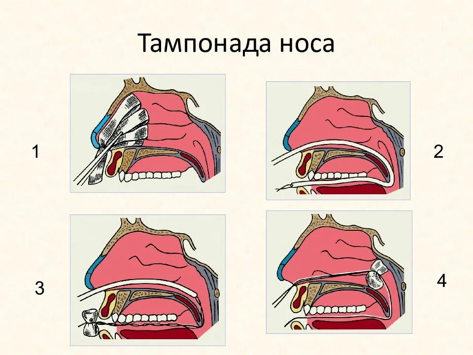 Передняя тампонада при носовом кровотечении