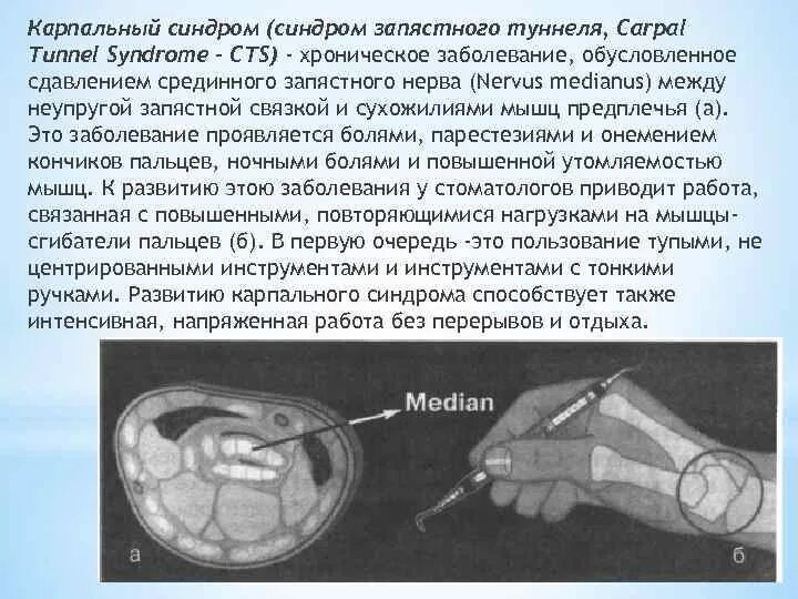 Туннельный синдром врачи. Синдром на карпальный туннель. Карпальный синдром запястья УЗИ. Синдром карпального канала на УЗИ. Карпальный туннельный синдром на УЗИ.