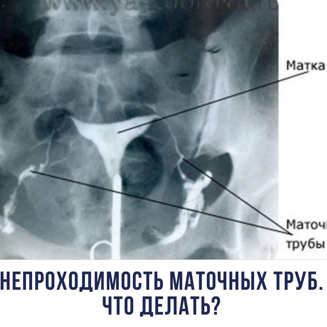 Можно забеременеть при непроходимости труб. Рентген снимок маточных труб. МСГ маточных труб снимок. Непроходимость маточных труб рентген.