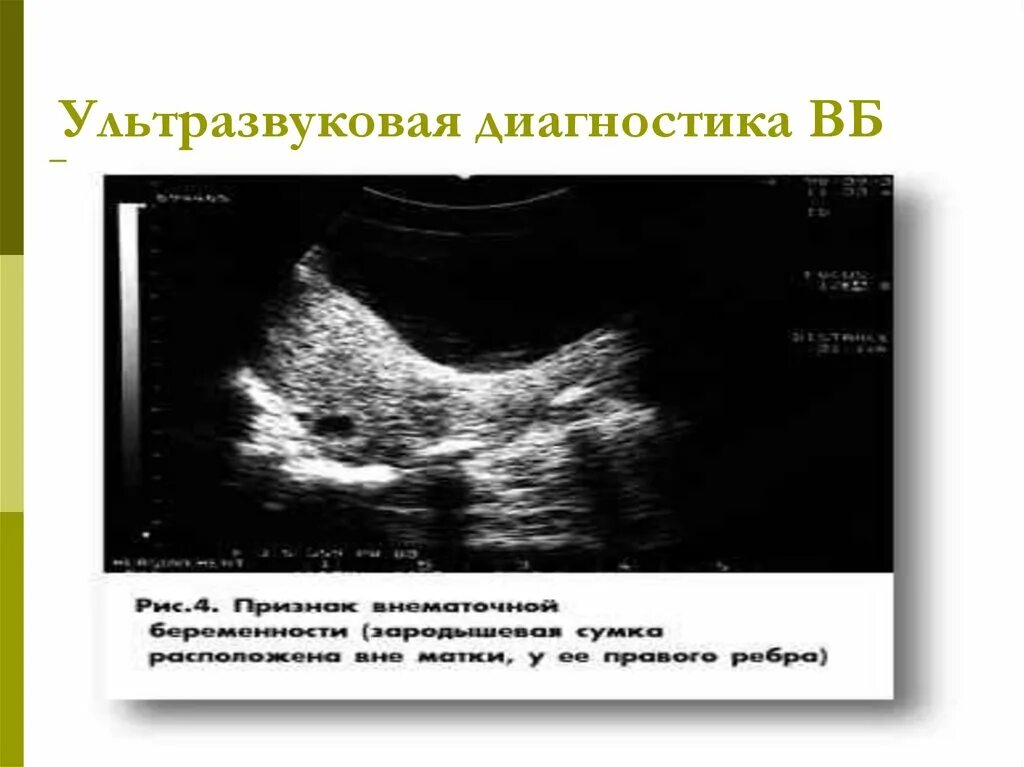 Шеечная внематочная беременность УЗИ. Внематочная беременность в яичнике на УЗИ. Интерстициальная беременность по УЗИ. УЗИ при апоплексии яичника.