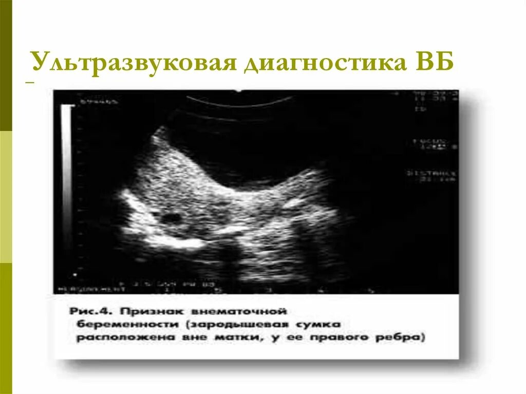 Тянет яичник при беременности на ранних. Шеечная внематочная беременность УЗИ. Внематочная беременность в яичнике на УЗИ. Интерстициальная беременность по УЗИ. УЗИ при апоплексии яичника.