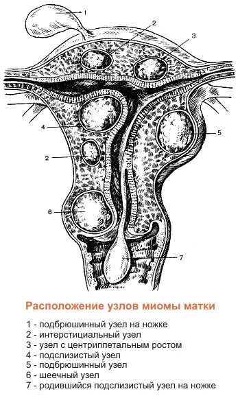 Узлы в матке размеры. Миома матки размеры в неделях и сантиметрах таблица. Множественная миома матки. Субмукозная фибромиома матки. Узлы в матке размеры.