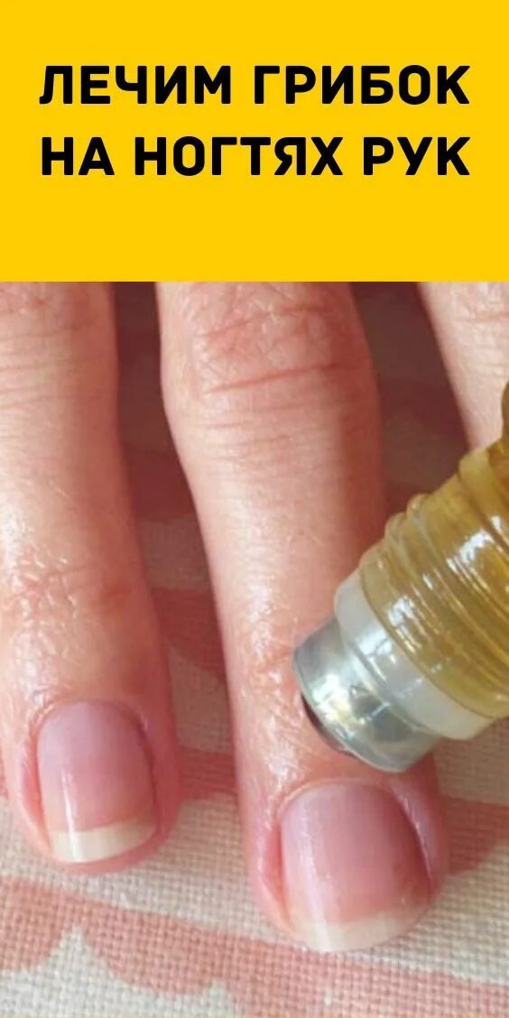 Как выглядит грибок ногтей пальцев рук Pin by shola smith on FUNGUS NAIL TREATMENT AND NAIL CRE Pretty toe nails, Ingro