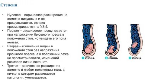 Степени варикоцеле