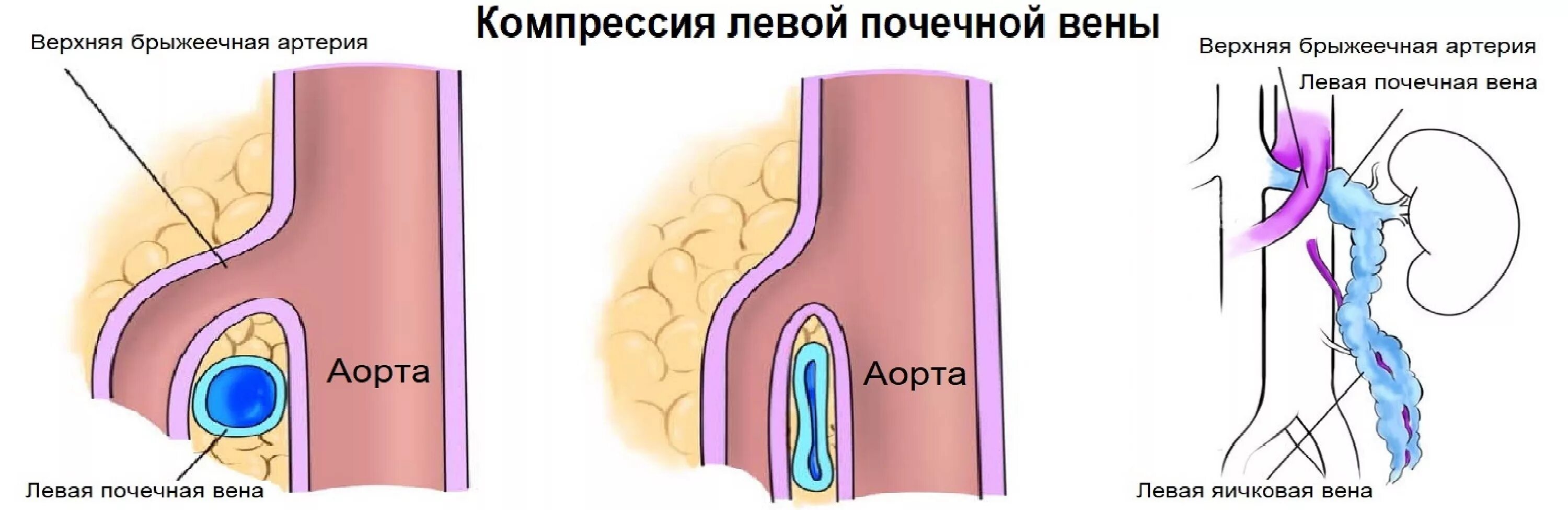 Синдром сдавления левой почечной вены. Компрессия левой почечной вены. Аорто-мезентериальной компрессии левой почечной вены.. Стентирование левой почечной вены. Вена левого яичка