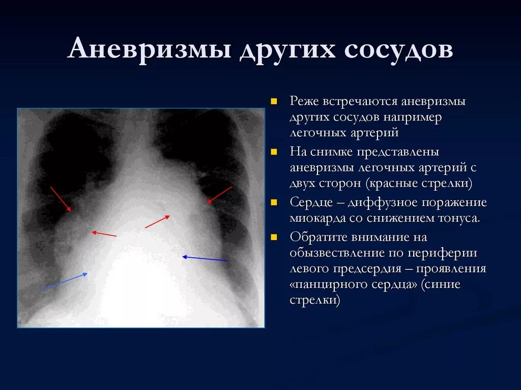 Аневризма нисходящего отдела аорты на рентгене. Аневризматическое расширение легочной артерии. Аневризма легочных сосудов. Разрыв аневризмы легочной артерии.