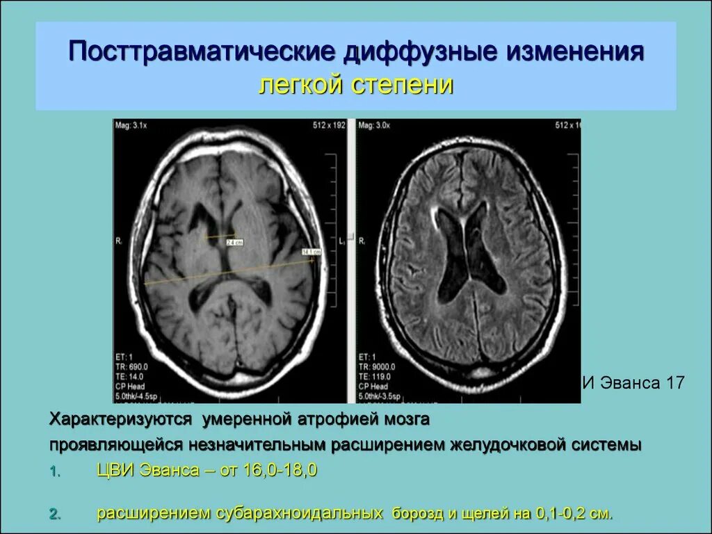 Диффузные нарушения мозга. Атрофические изменения головного мозга кт. Диффузные изменения головного мозга. Диффузные изменения головного мозга на мрт.