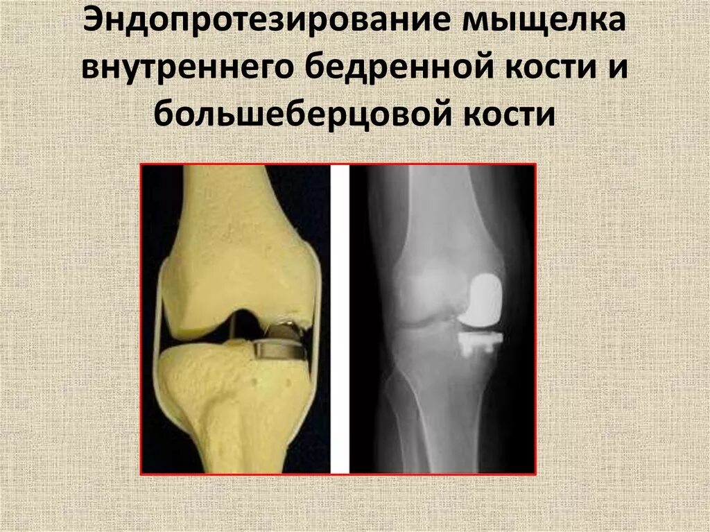 В суставе мыщелок. Большеберцовая кость мыщелка. Перелом мыщелков большеберцовой кости. Импакция мыщелка большеберцовой. Перелом латерального мыщелка бедренной кости.