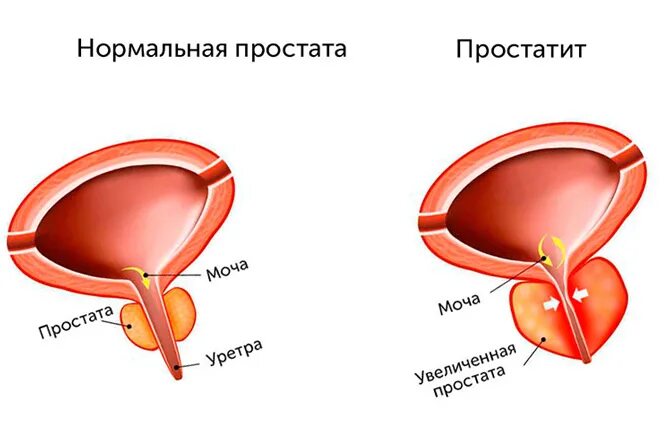 Шелуха от простатита. Влияние кофе на простату. Методы воздействия на простату. Простатит и кофе.