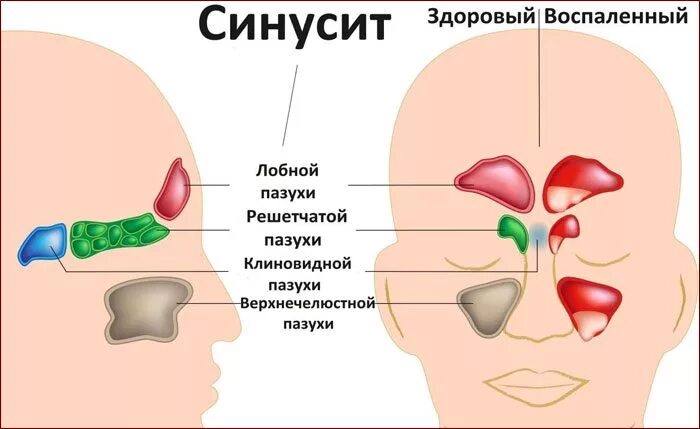 Воспаление лобной пазухи.